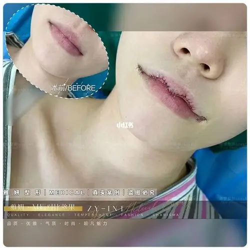 m微笑唇术后对比_微笑唇_m唇_美妆_医美整形