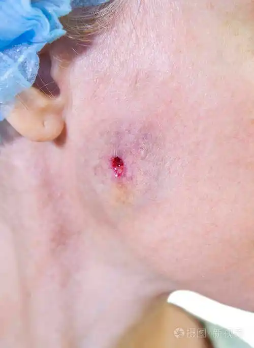 照片系列美容并发症清除严重未吸收threa后颊部瘘刮伤后的伤口