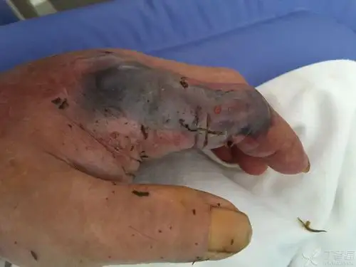 相关疾病: 毒蛇咬伤中毒 破伤风