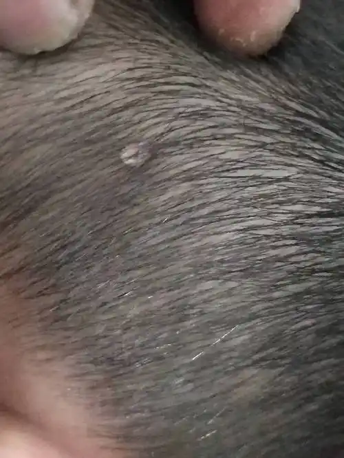 小孩头后脑勺上长了个半公分长的小肉瘤一样的长长东西是什么