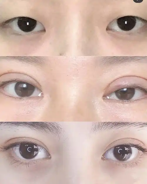 割双眼皮术后几天照片