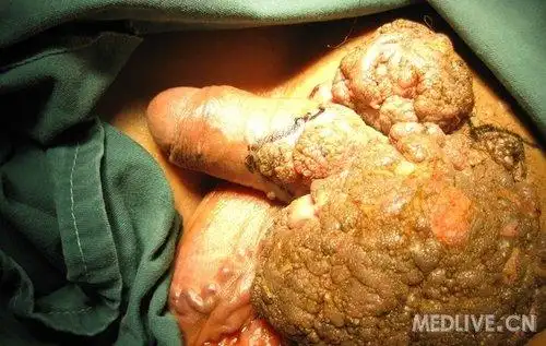 慎入阴囊阴茎根部肿块有病理