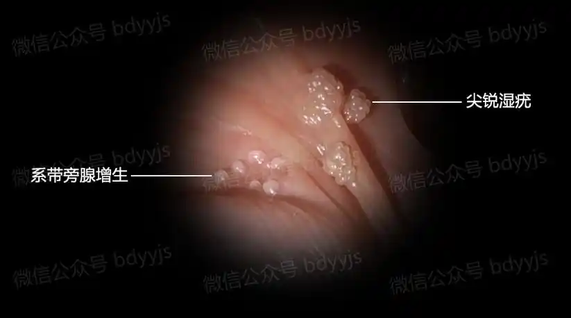 男性真假尖锐湿疣图片