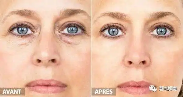 眼睛衰老怎么破恢复年轻态有办法