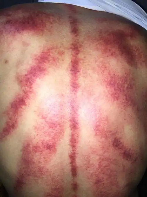 昨天我刮痧了 背部就是这种颜色 这说明了什么?