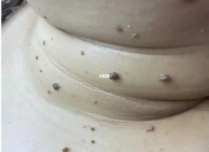 9799丝状疣 1,湿寒过重,淋巴不畅,经络不通.