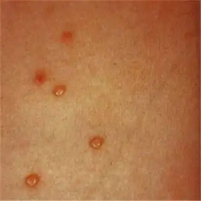 性病的症状图 (127)