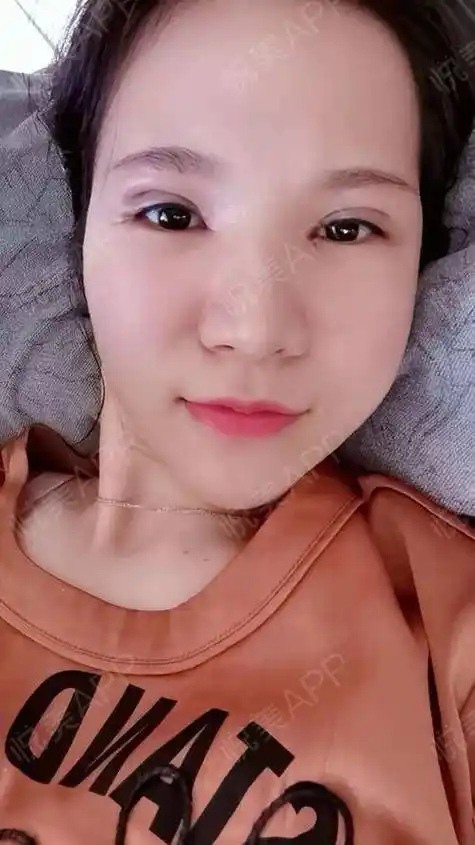 割双眼皮两个月的图片?双眼皮割得很好看是一种什么体验