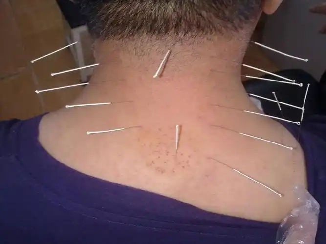 中医针灸治疗颈椎病哦