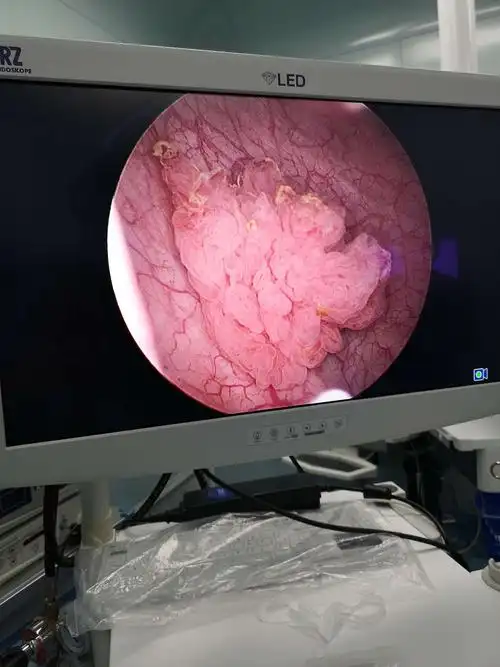 保卫膀胱—我院泌尿外科成功完成1例等离子棒状电极膀胱肿瘤剜除术.