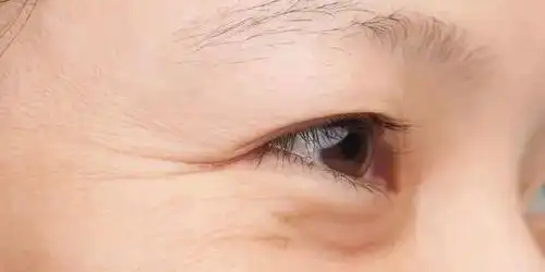 眼角的鱼尾纹就是眼睛肌肤的松弛和老化.