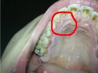 问:口腔白斑吗?请问这个是什么情况?