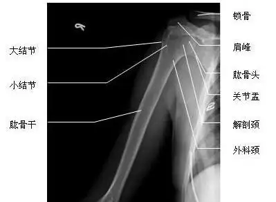 肱骨正位(x射线图)