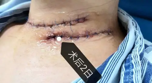 第三鳃裂瘘是个什么鬼?(副本)