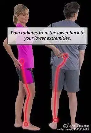 (1)疼痛是梨状肌综合症的主要表现.