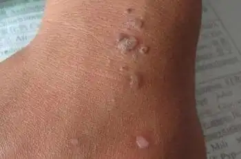 hpv有什么表现症状女性照片图真实女性早期hpv感染图片