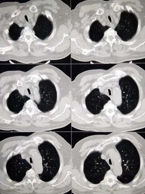 这个肺部肿瘤藏得深,胸片分分钟漏诊,追踪下来该来的都来了 [病例帖]