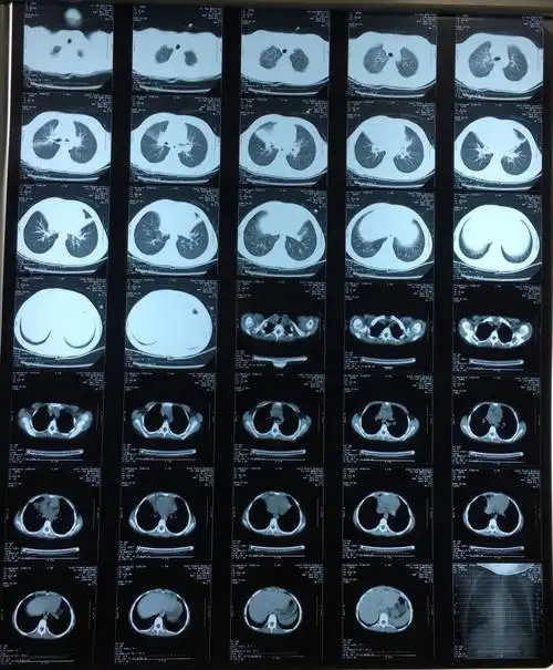 入院后查胸部ct提示右肺中叶及左肺舌叶肺炎
