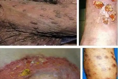 淋病的早期症状照片淋病吃什么药好的快