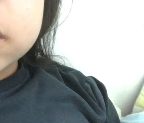 脸肿成蜡笔小新了怎么办