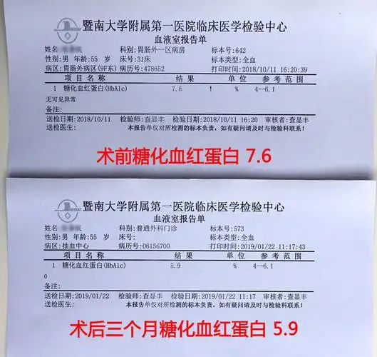 胃旁路术后三个月,糖化血红蛋白正常了!