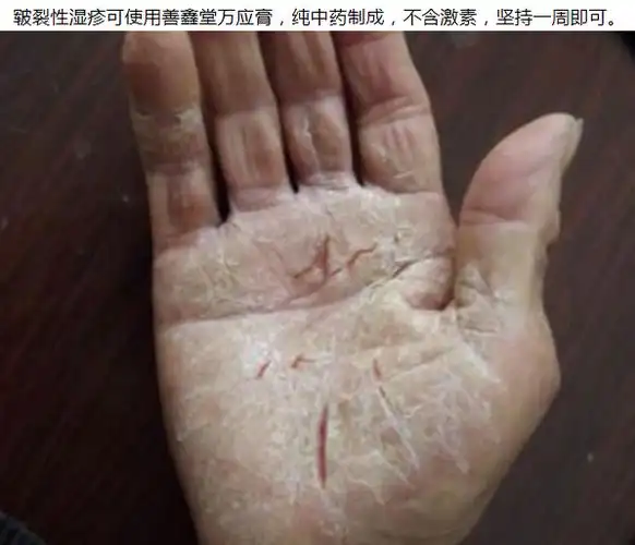 如何治疗皲裂性湿疹,皲裂治疗的三种方法?