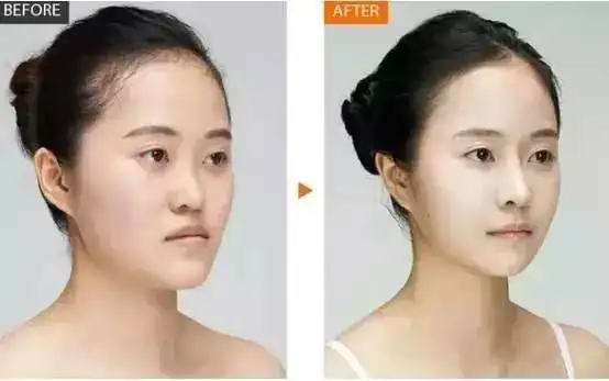 挺鼻子和塌鼻子对比照