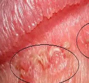 尖锐图片湿疣图片_尖锐湿疣_女性湿疣