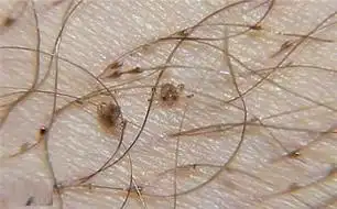 虱子卵离开人体能存活多久