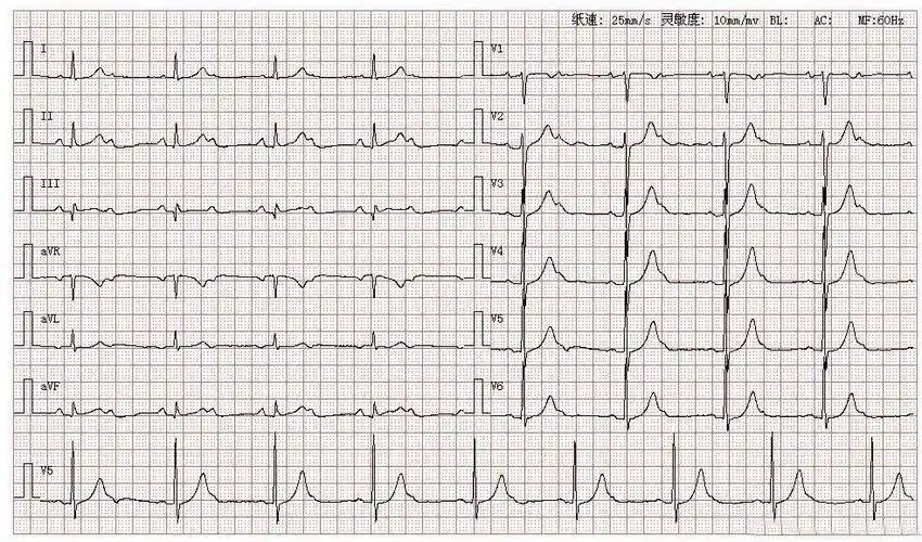 心电图图谱 6如图所示,患者p波在Ⅰ,Ⅱ,avf,v4-v6导联直立向上,avr