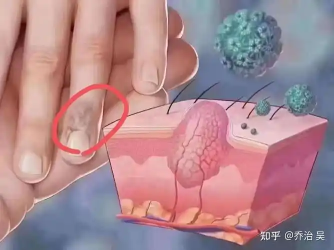 如何区分皮赘和丝状疣? - 知乎
