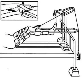 图8-10 股骨骨折持续骨牵引3)兜带牵引(图8-11)①枕颌带牵引:用于颈椎