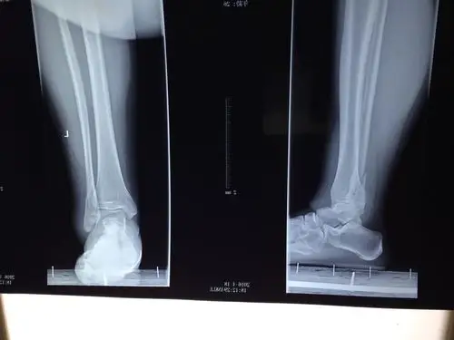 自己穿高跟鞋跑的,转弯不小心摔跤了,请问左腓骨下端及后踝骨折,断端