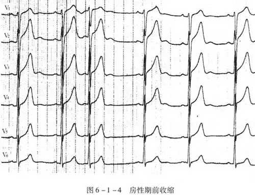 临床诊断:前期收缩原因待查.  心电图分析:窦性心律,心率62次/分.