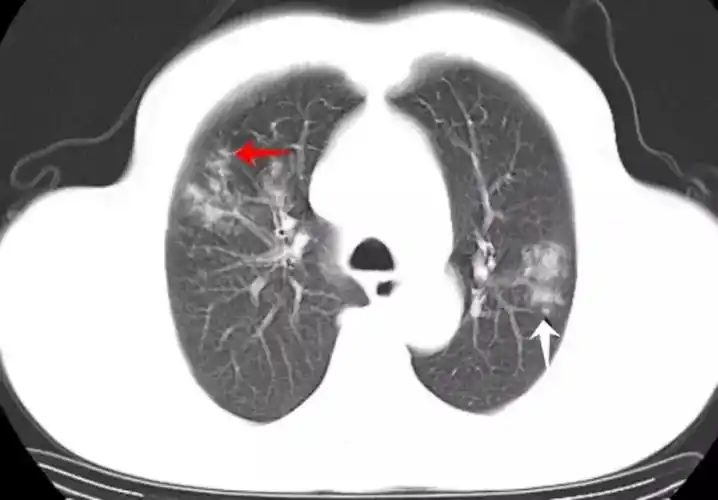 金黄色葡萄球菌肺炎,大咖教你看ct片!