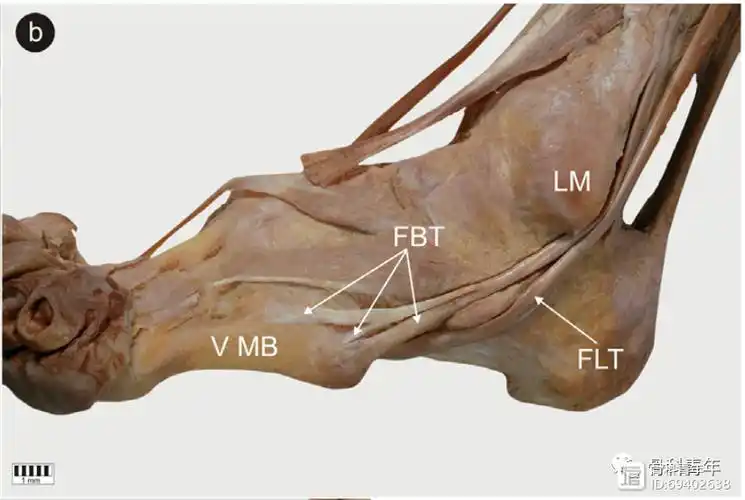 腓骨短肌(fibularis brevis muscle,fbm)止点分型