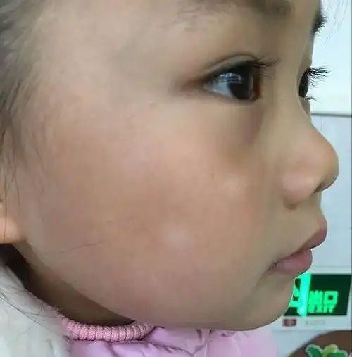 宝宝脸上出现白斑是要打虫吗要吃打虫药吗