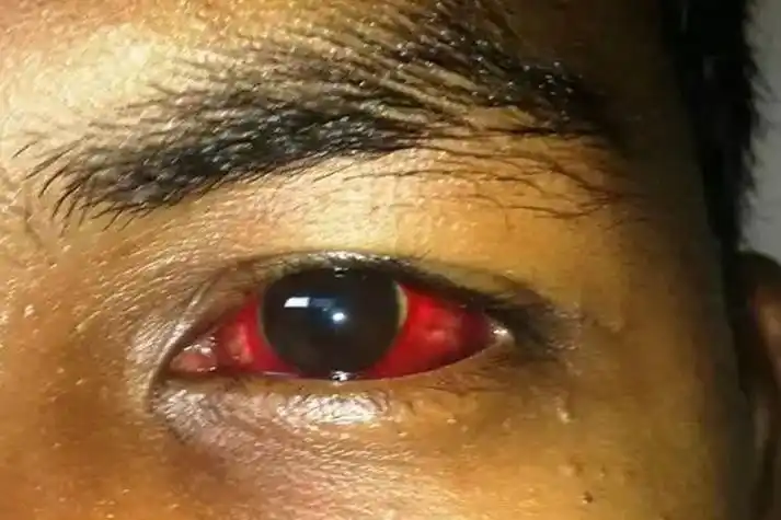 早期结膜充血图