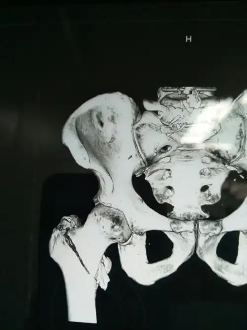 右股骨转子间骨折一例. - 美篇