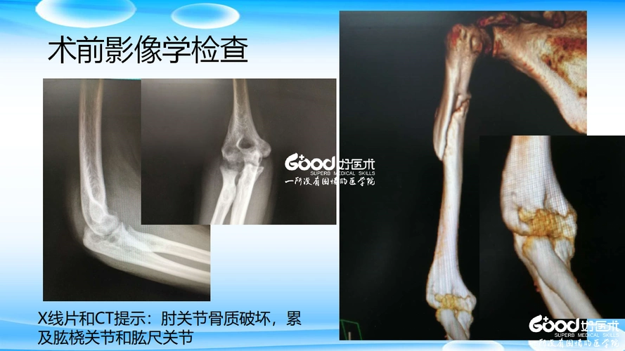 肘关节y形成形术治疗肱骨远端粉碎性骨折