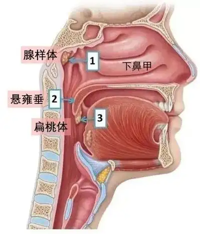 腺样体手术后为何孩子仍打呼张嘴呼吸黑眼圈严重