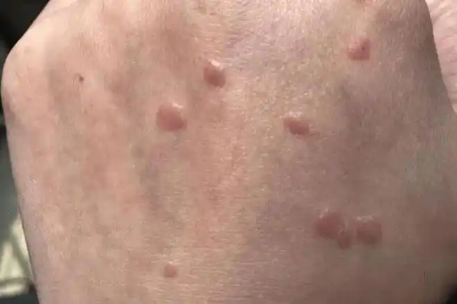 比如在脸颊,脖子还有私处外阴等部位出现有红点,说明是hpv病毒感染