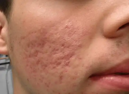 橘皮样皮肤图片 (30)_有来医生