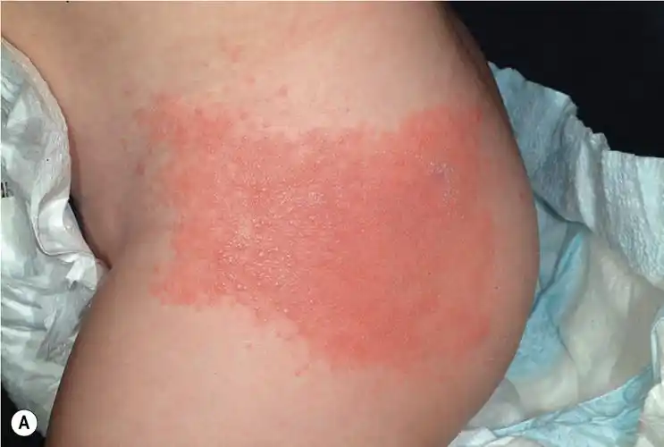 接触性皮炎有什么主要症状?