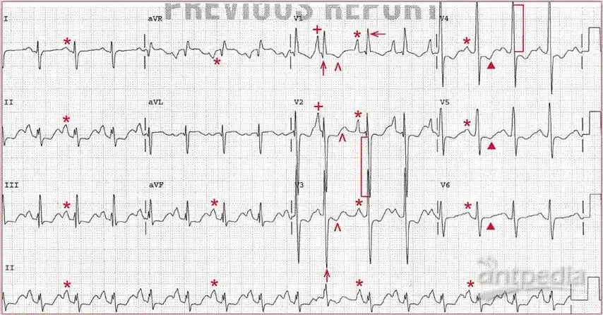 心电图分析p波高尖是肺性p波吗