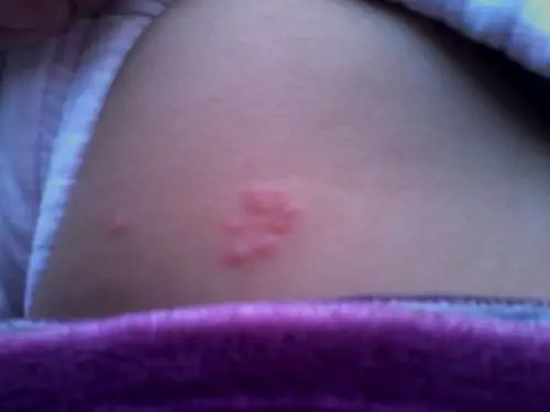 18月小孩身上起了几个水泡,不知道是不是蛇胆疮,现