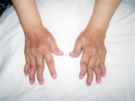 手指类风湿关节炎症状类风湿关节炎早期症状2022已更新今日热点