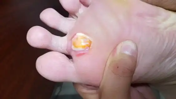 警惕:"鸡眼"处理不当感染骨髓炎,险被截肢!