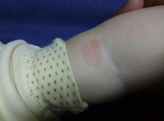 宝宝快七个月了今天胳膊上张了一小片红红的好像是皮癣好怕怕啊