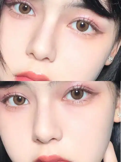 眼睛是心灵的窗户,一双美丽_圈子-新氧美容整形